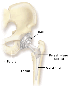 New-Hip Concerns