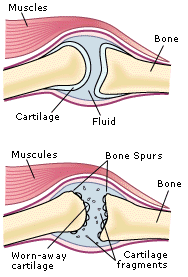 Osteoarthritis